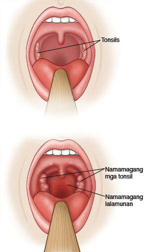 Dalawang malapit na tanaw ng lalamunan na nagpapakita ng normal na mga tonsil at magang mga tonsil sa lalamunan.