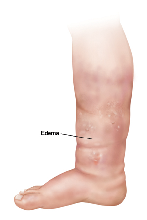 Edema