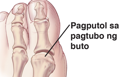 Paglago ng buto sa malaking daliri