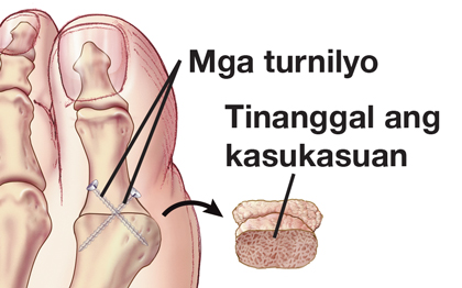 Pagputol ng paglago ng buto sa malaking daliri