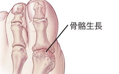 大腳趾的骨骼生長