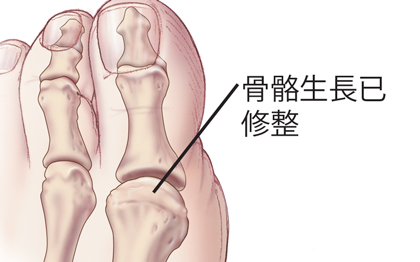 對大腳趾的骨骼生長進行了修整