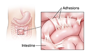 Anterior view of child's abdomen showing stomach and intestines. Inset shows adhesions.