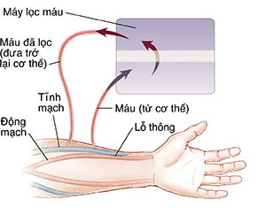 Cánh tay cho thấy lỗ thông giữa tĩnh mạch và động mạch. Ống thông lọc máu luồn vào tĩnh mạch đưa máu từ cơ thể đến máy lọc máu rồi đưa máu trở lại cơ thể.