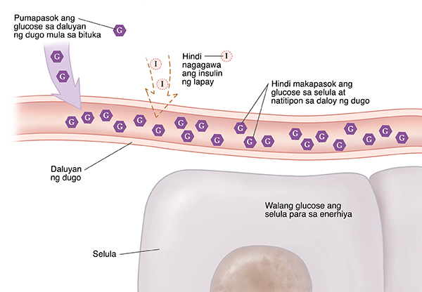 Closeup cross section ng daluyan ng dugo na malapit sa mga selula na ipinapakita ang Type 1 diabetes. Hindi nagagawa ang insulin. Hindi makapasok ang glucose sa mga selula at natitipon sa daloy ng dugo. Walang glucose ang selula para sa enerhiya.